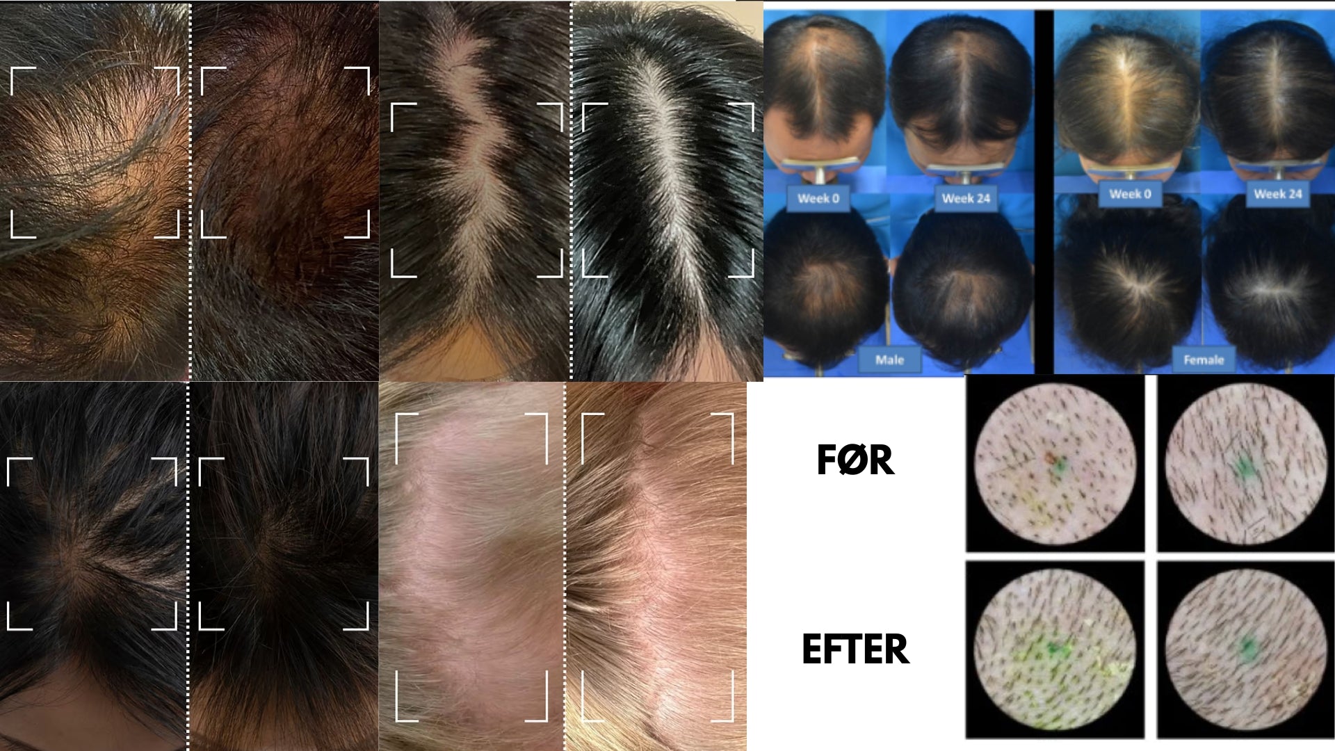 hairboom før efter 24 uger